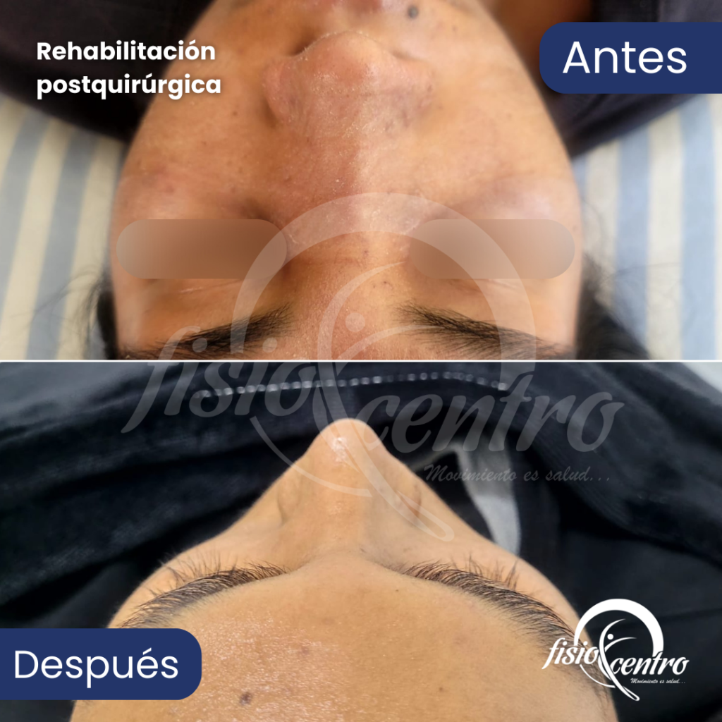 Rehabilitación Postquirúrgica