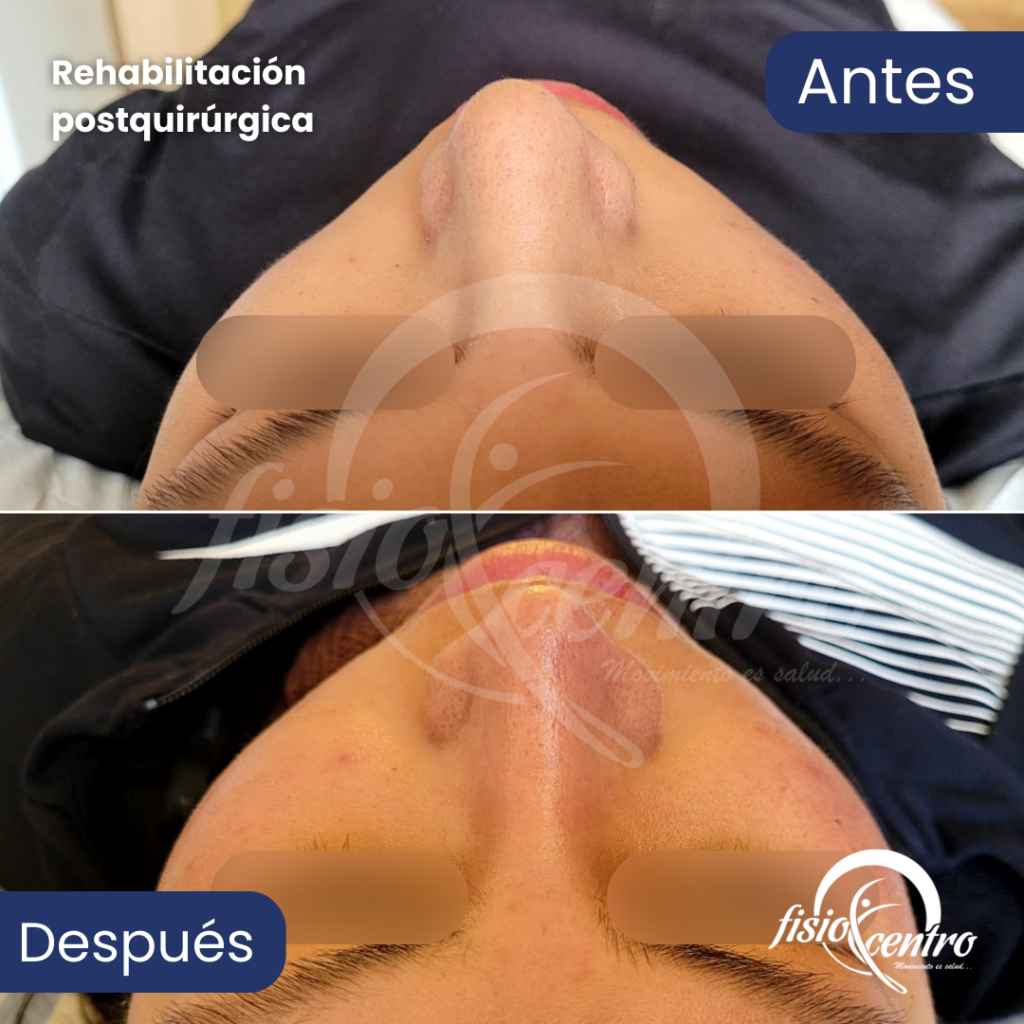 Rehabilitación Postquirúrgica