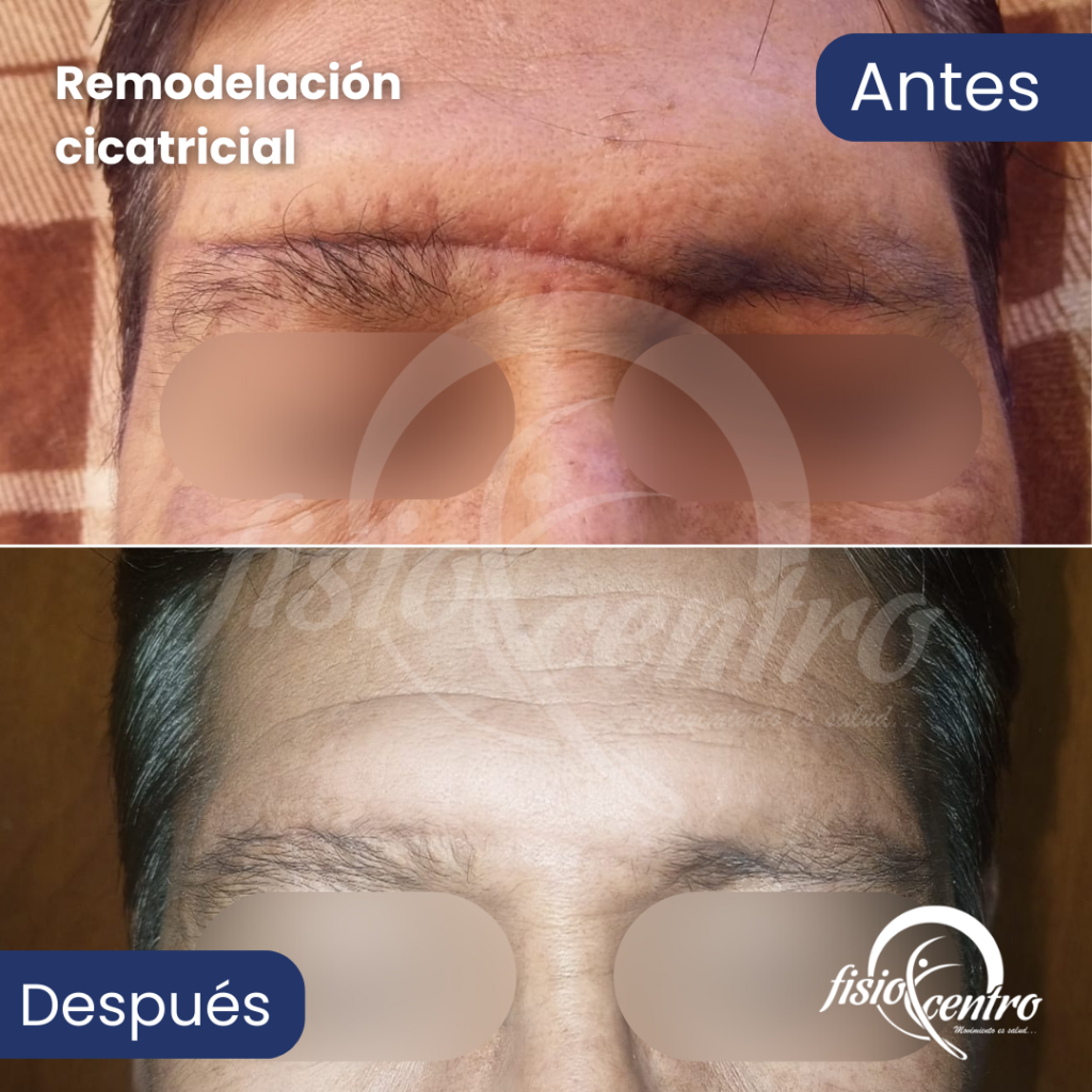Remodelación Cicatrical