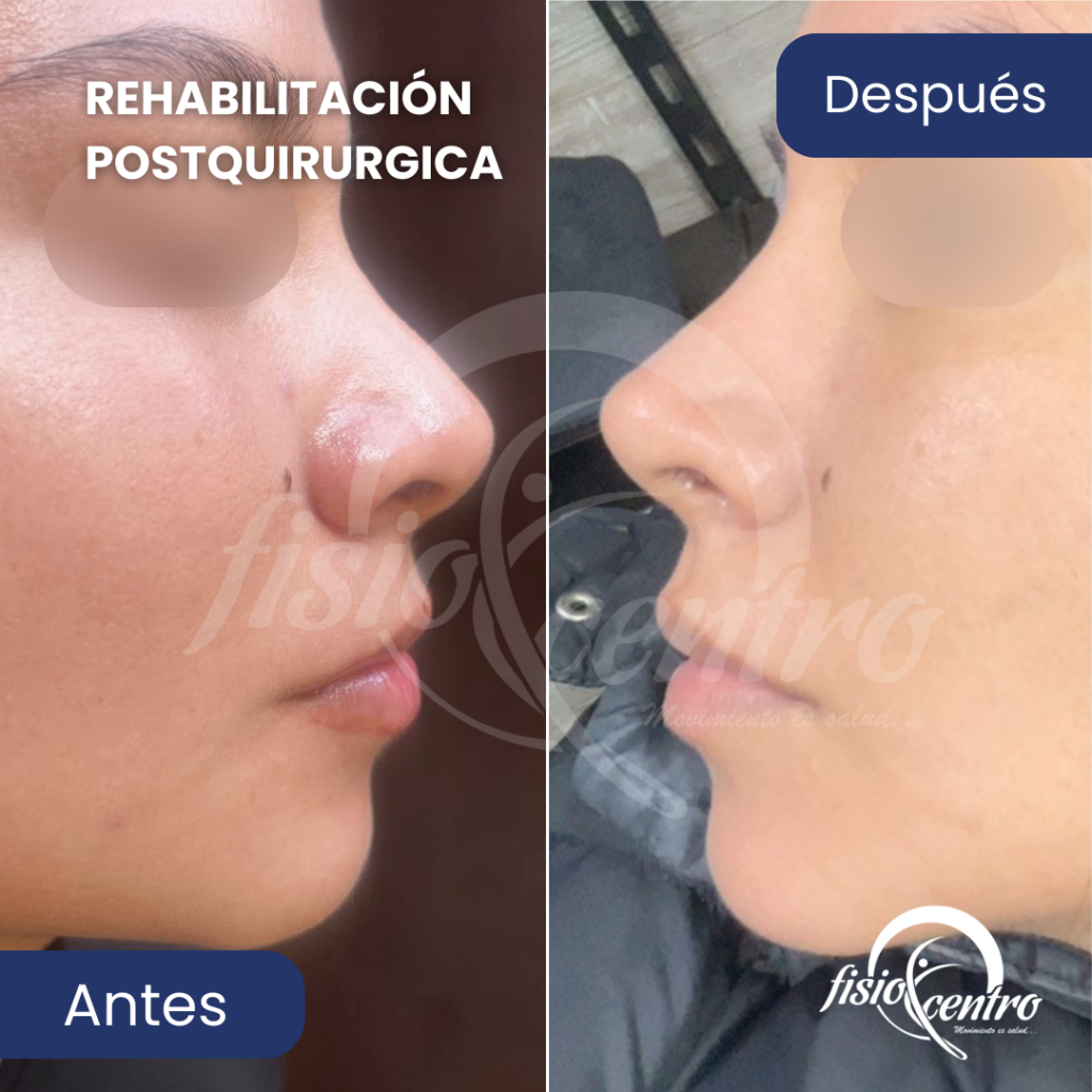 Rehabilitación Postquirúrgica